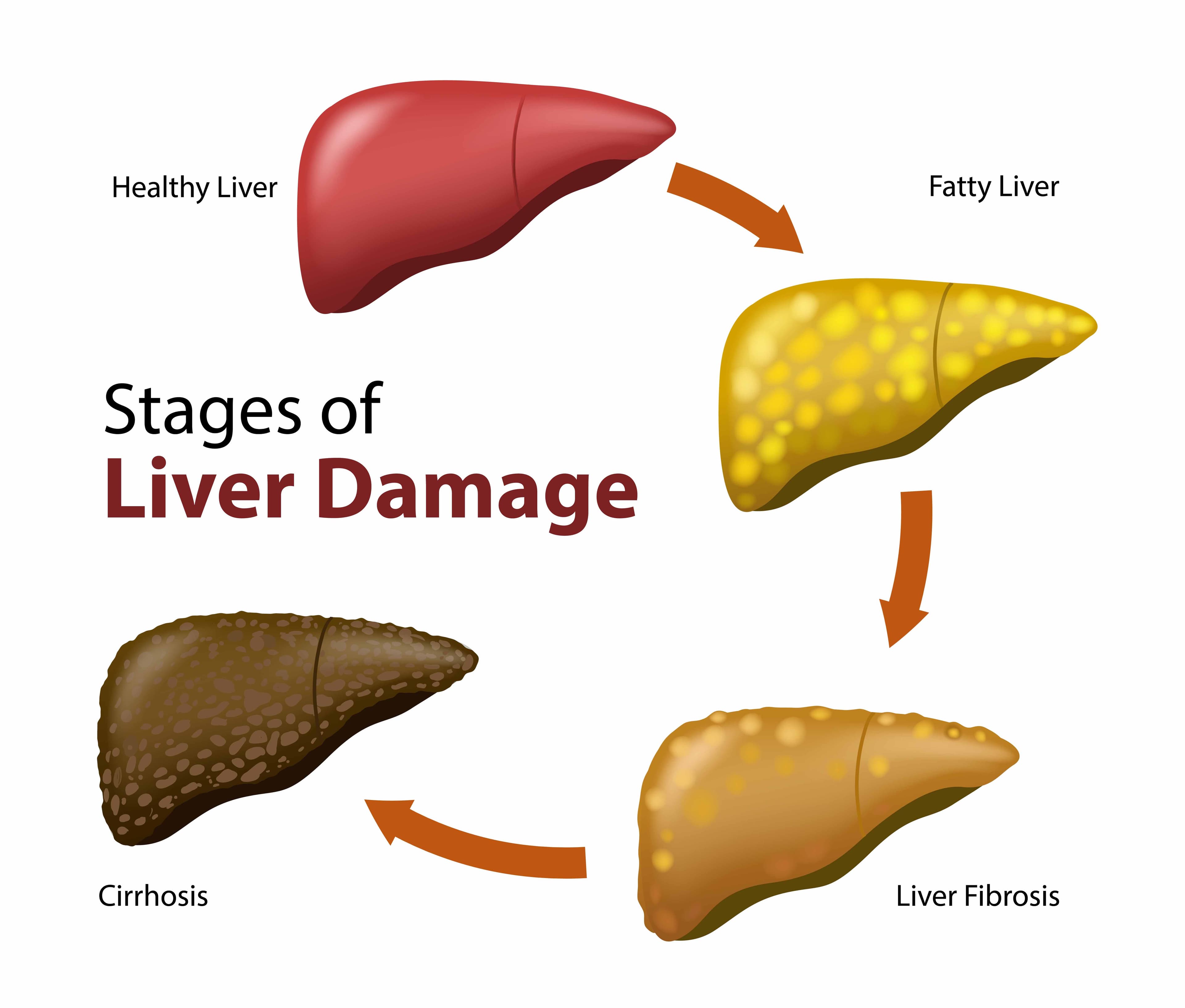 Causes of Fatty Liver and Its Treatment Causes of Fatty Liver and Its Treatment